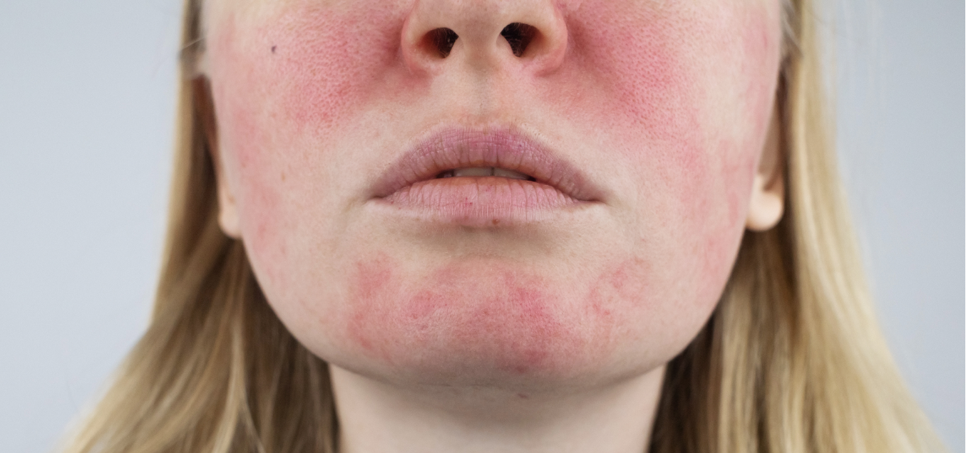 Melasma