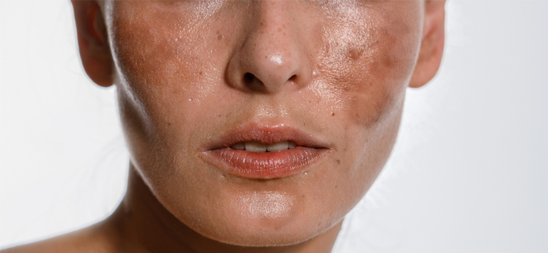 Melasma